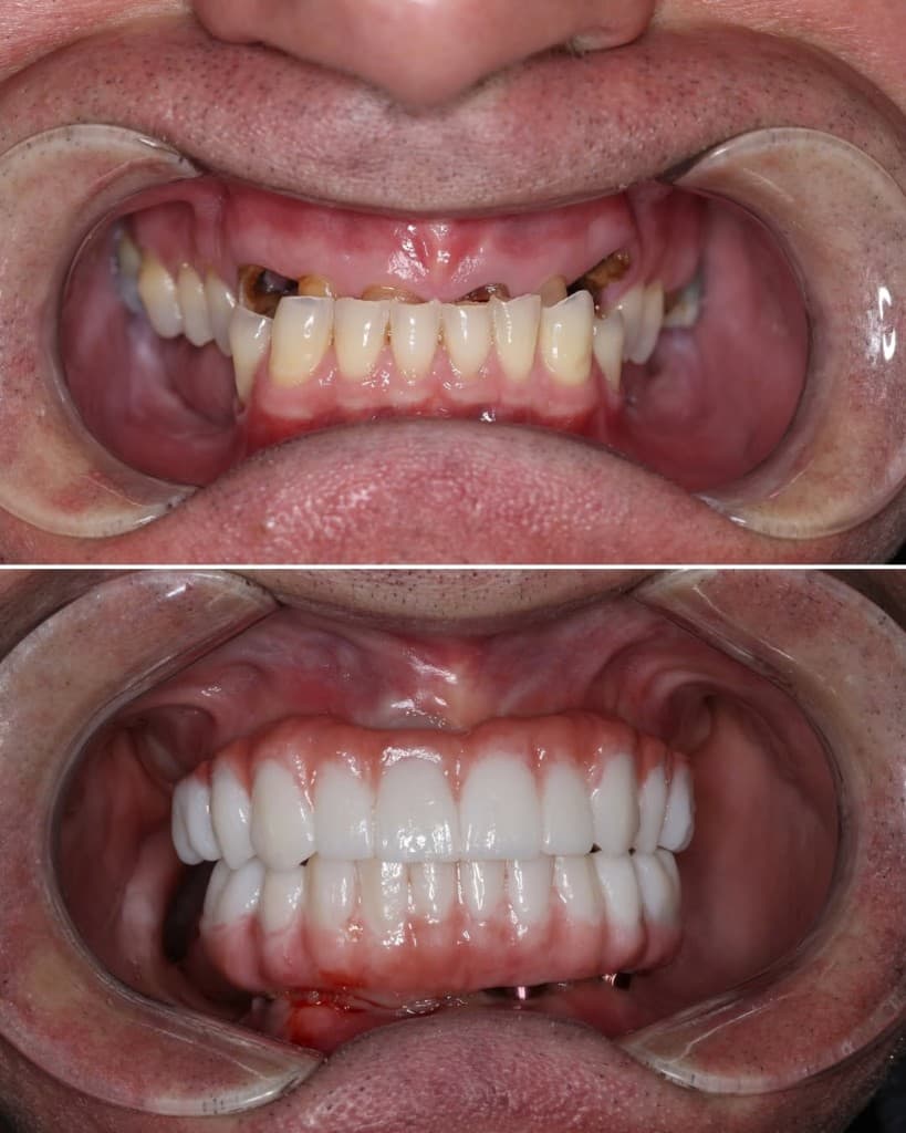 Before and after dental restoration at Ghisalberti Dental